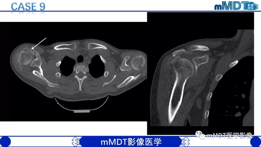 【PPT】痛风的影像学诊断与鉴别