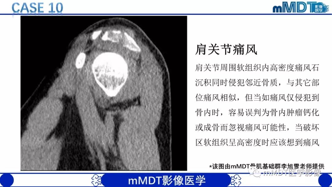 【PPT】痛风的影像学诊断与鉴别