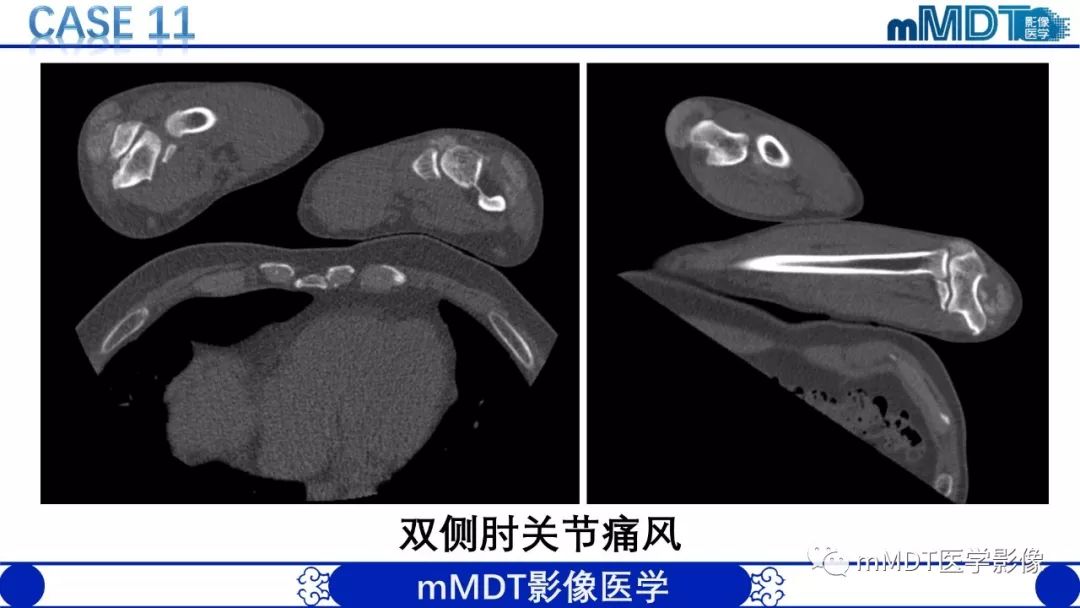 【PPT】痛风的影像学诊断与鉴别