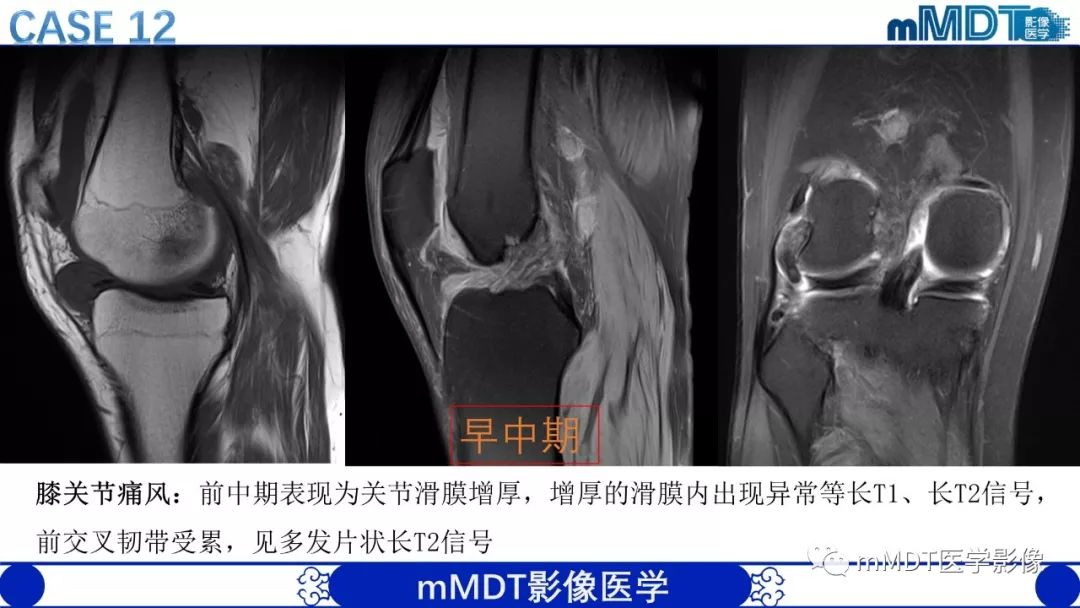 【PPT】痛风的影像学诊断与鉴别