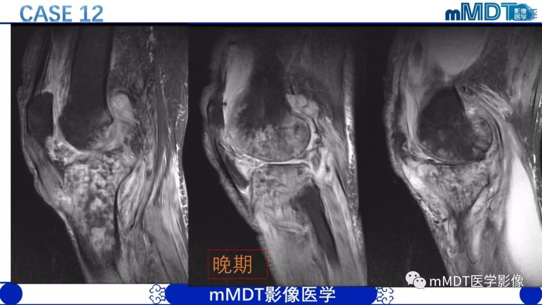【PPT】痛风的影像学诊断与鉴别