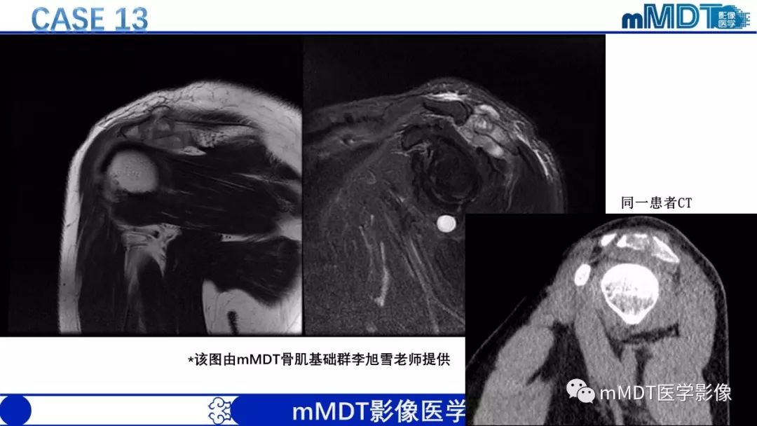 【PPT】痛风的影像学诊断与鉴别