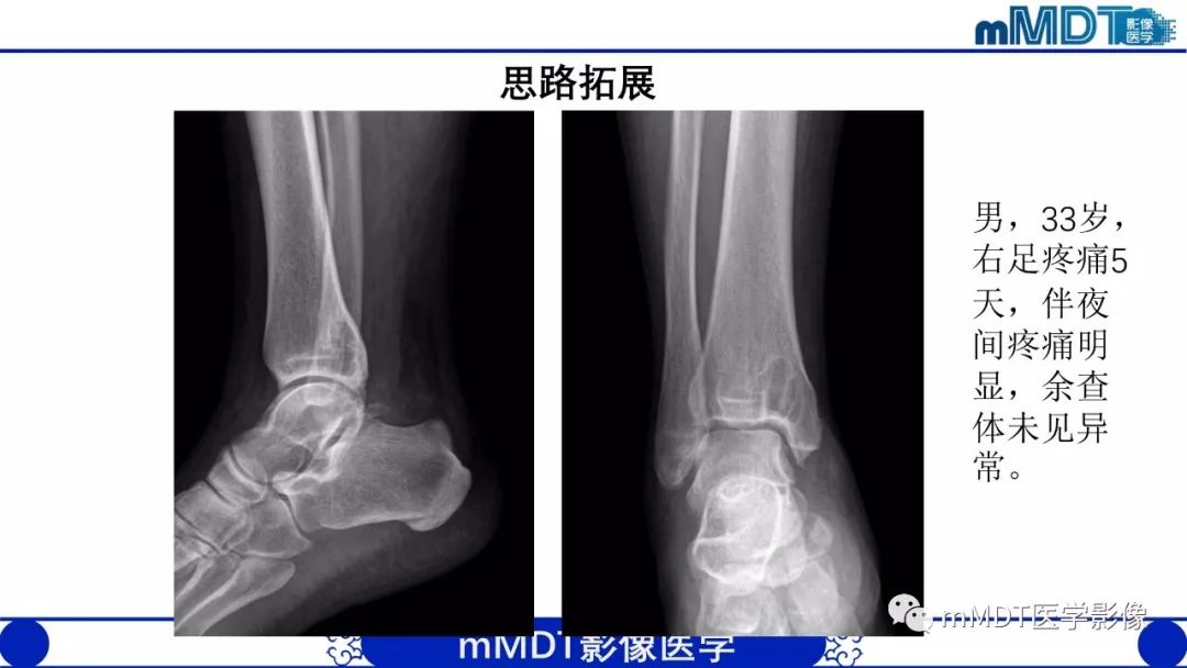 【PPT】痛风的影像学诊断与鉴别