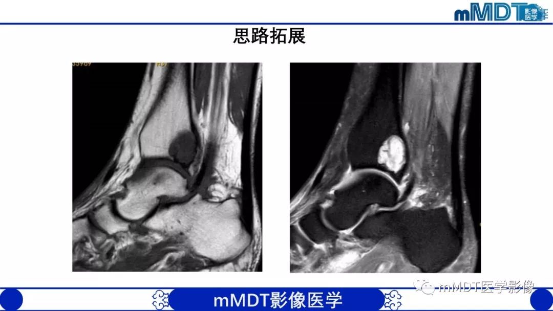 【PPT】痛风的影像学诊断与鉴别