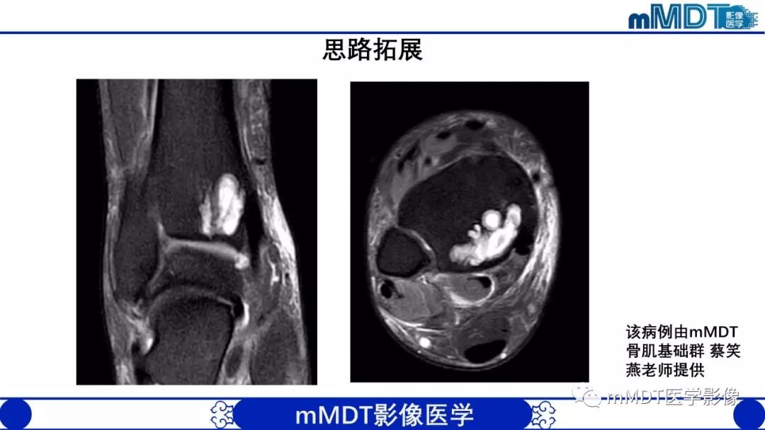 【PPT】痛风的影像学诊断与鉴别