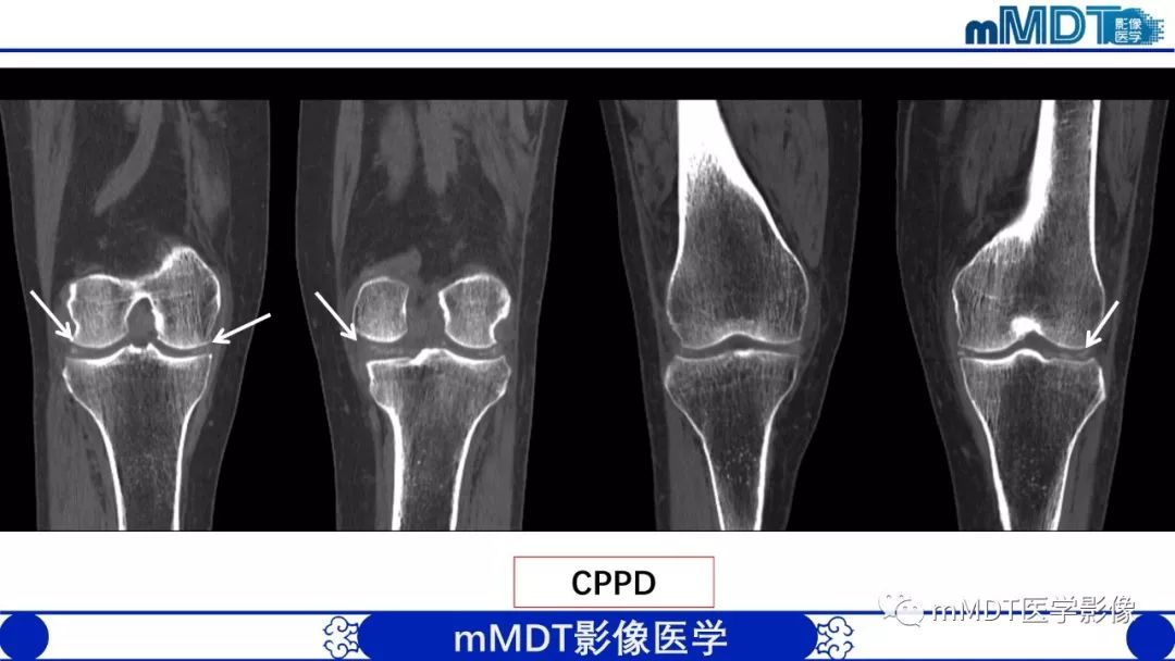 【PPT】痛风的影像学诊断与鉴别