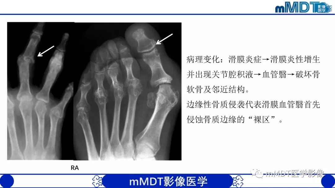 【PPT】痛风的影像学诊断与鉴别