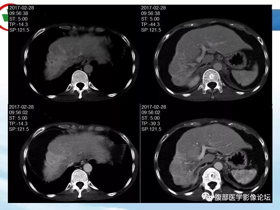 【病例】肝脏局灶融合性纤维化1例CT影像 【病例】肝脏局灶融合性纤维化1例CT影像