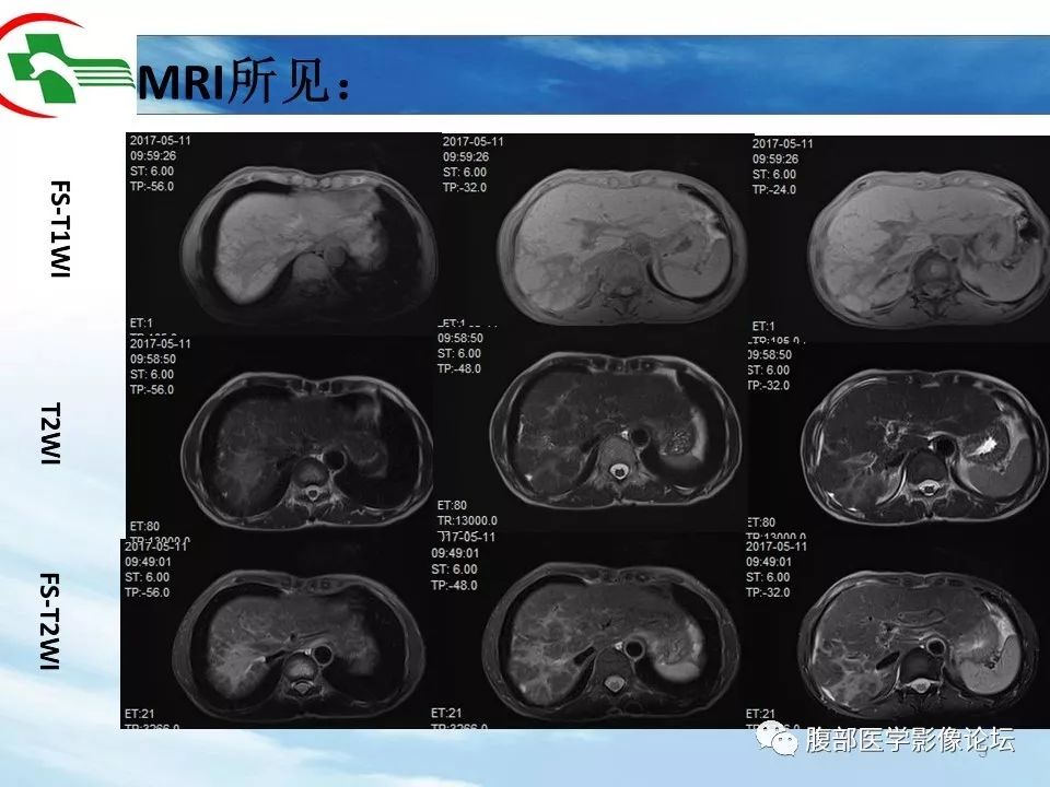 【病例】肝脏局灶融合性纤维化1例CT影像 【病例】肝脏局灶融合性纤维化1例CT影像