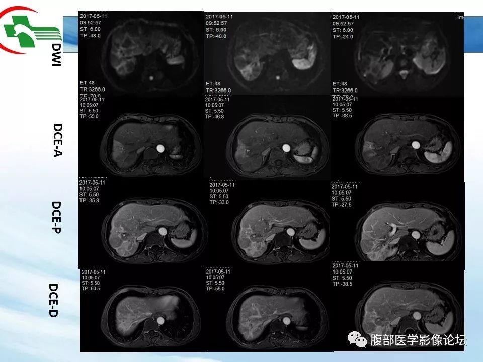 【病例】肝脏局灶融合性纤维化1例CT影像 【病例】肝脏局灶融合性纤维化1例CT影像