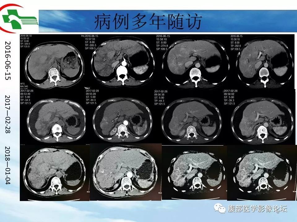 【病例】肝脏局灶融合性纤维化1例CT影像 【病例】肝脏局灶融合性纤维化1例CT影像