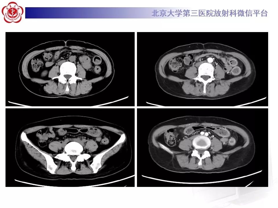 【病例】炎症性肠病-溃疡性结肠炎1例CT影像