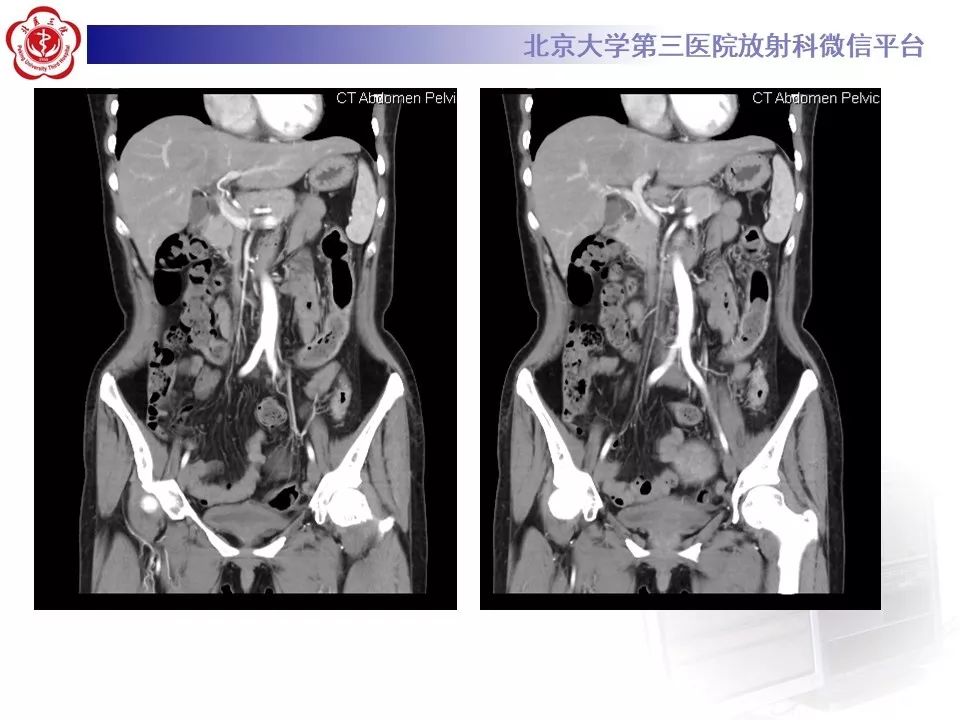 【病例】炎症性肠病-溃疡性结肠炎1例CT影像