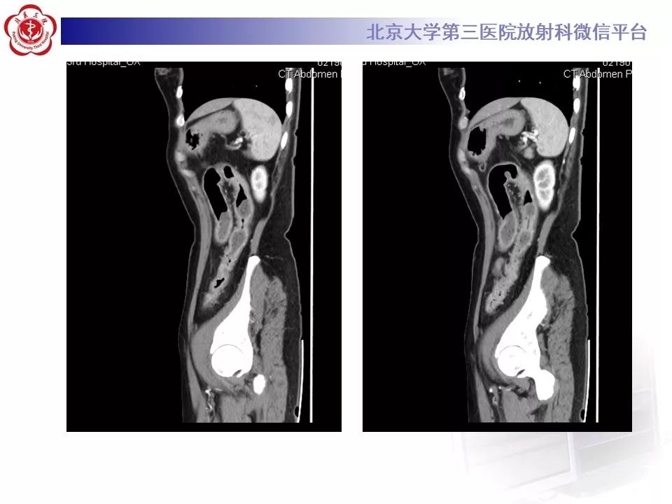 【病例】炎症性肠病-溃疡性结肠炎1例CT影像