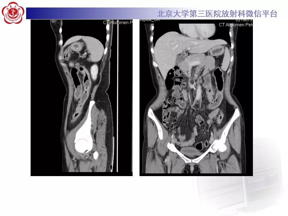 【病例】炎症性肠病-溃疡性结肠炎1例CT影像