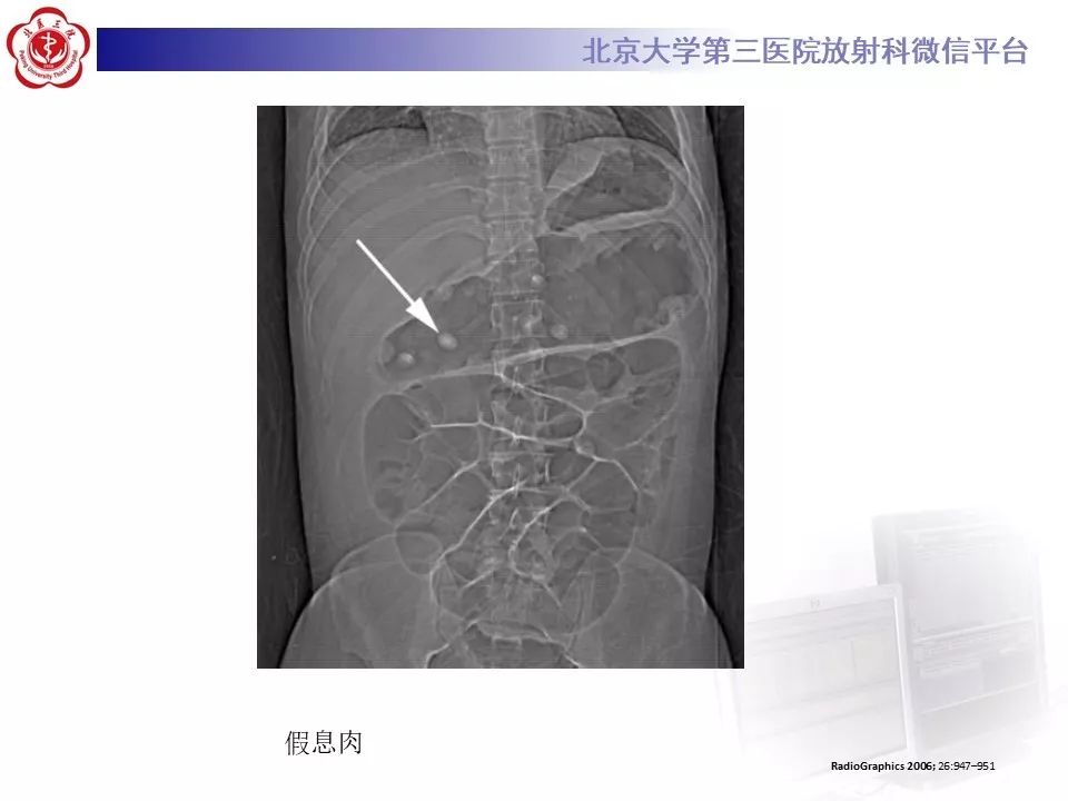 【病例】炎症性肠病-溃疡性结肠炎1例CT影像