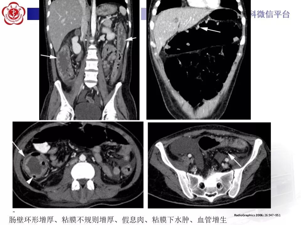 【病例】炎症性肠病-溃疡性结肠炎1例CT影像