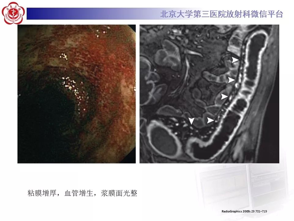【病例】炎症性肠病-溃疡性结肠炎1例CT影像