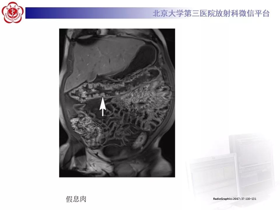 【病例】炎症性肠病-溃疡性结肠炎1例CT影像