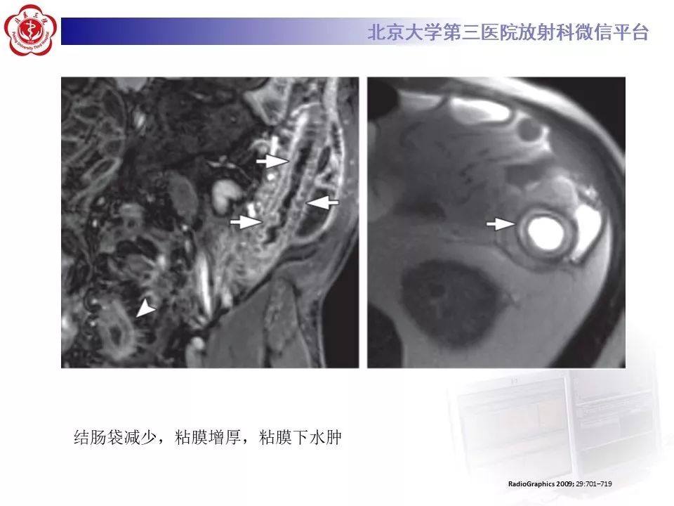 【病例】炎症性肠病-溃疡性结肠炎1例CT影像