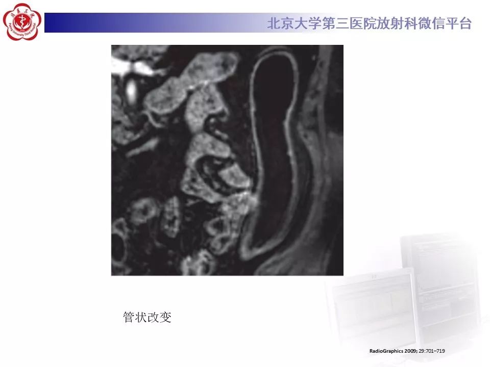 【病例】炎症性肠病-溃疡性结肠炎1例CT影像