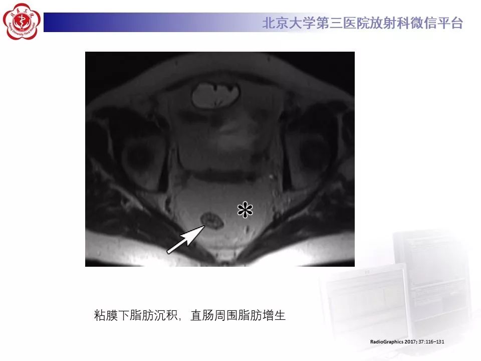 【病例】炎症性肠病-溃疡性结肠炎1例CT影像