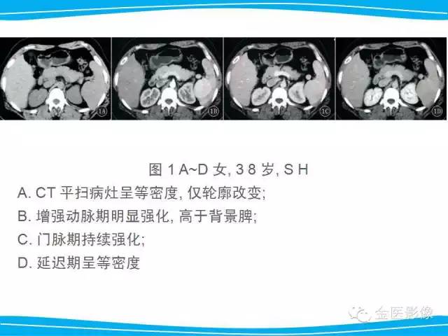 【PPT】脾脏错构瘤的影像表现