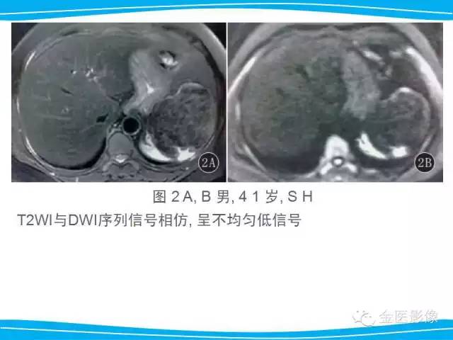 【PPT】脾脏错构瘤的影像表现