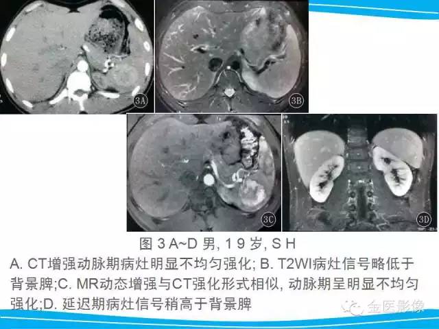 【PPT】脾脏错构瘤的影像表现