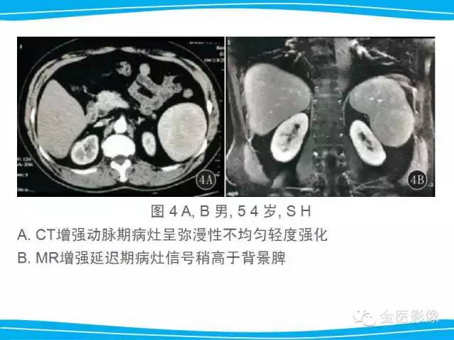 【PPT】脾脏错构瘤的影像表现