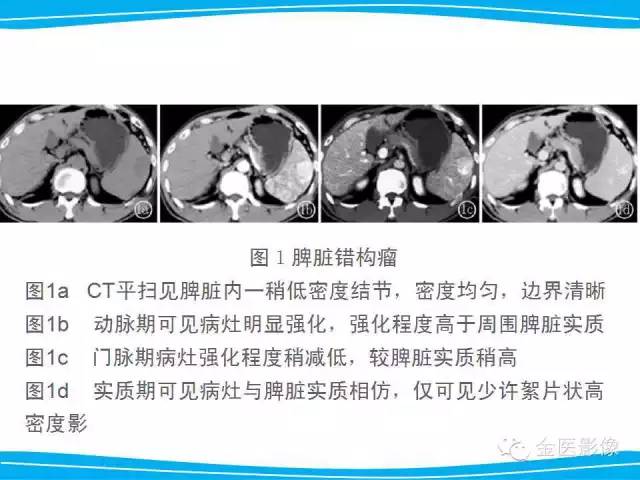 【PPT】脾脏错构瘤的影像表现