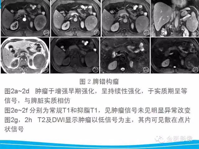 【PPT】脾脏错构瘤的影像表现