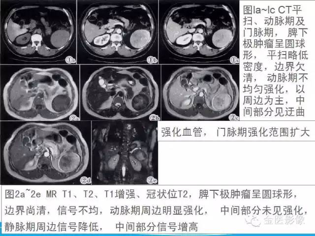 【PPT】脾脏错构瘤的影像表现