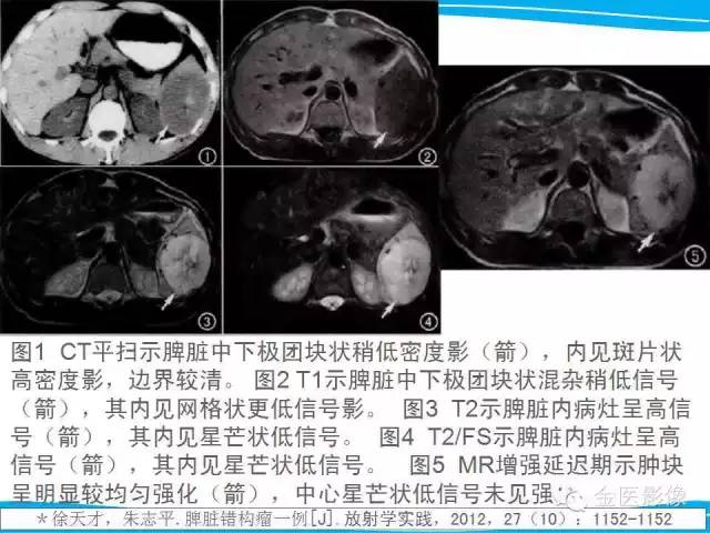 【PPT】脾脏错构瘤的影像表现