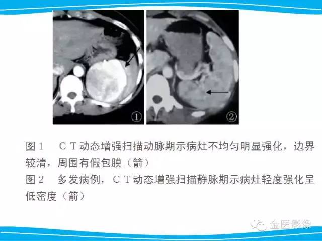 【PPT】脾脏错构瘤的影像表现