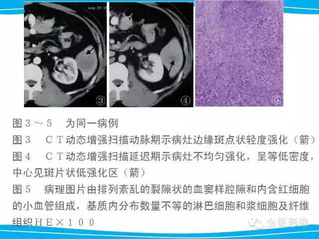 【PPT】脾脏错构瘤的影像表现