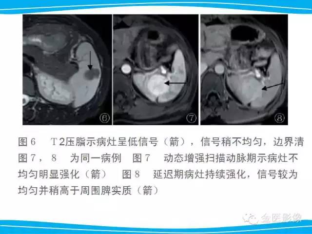 【PPT】脾脏错构瘤的影像表现