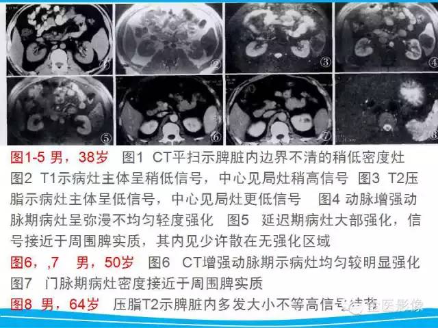 【PPT】脾脏错构瘤的影像表现