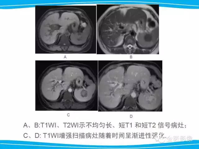 【PPT】脾脏错构瘤的影像表现