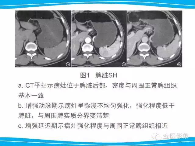 【PPT】脾脏错构瘤的影像表现