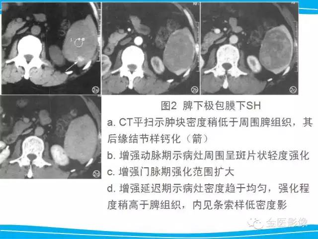 【PPT】脾脏错构瘤的影像表现