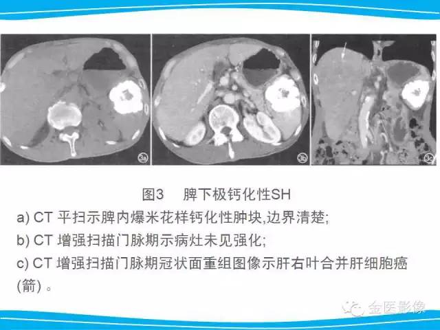 【PPT】脾脏错构瘤的影像表现