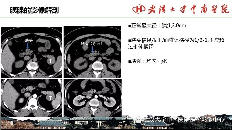 【PPT】胰腺正常解剖及形态变异、先天性疾病