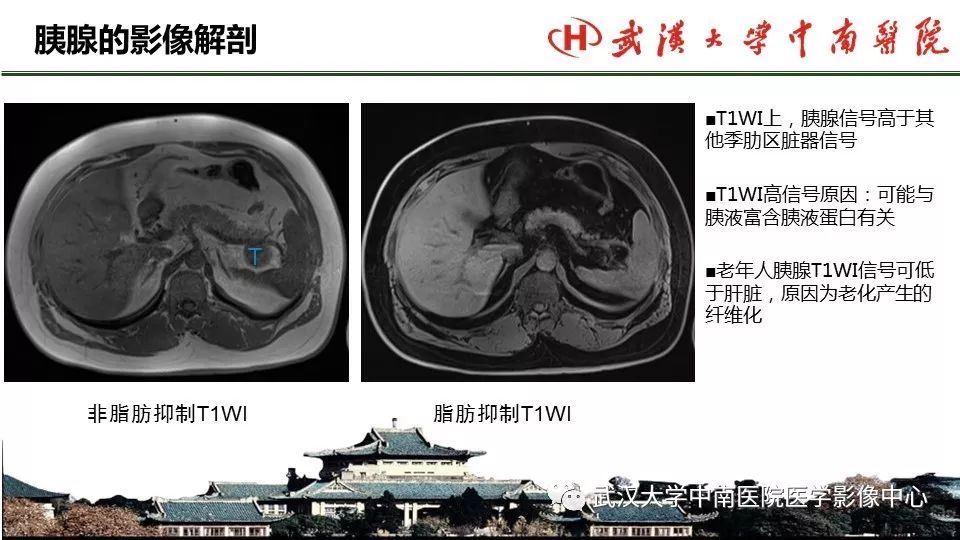 【PPT】胰腺正常解剖及形态变异、先天性疾病
