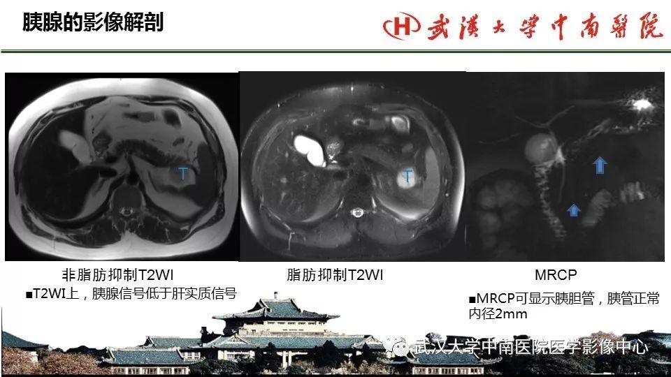 【PPT】胰腺正常解剖及形态变异、先天性疾病