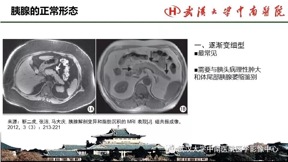 【PPT】胰腺正常解剖及形态变异、先天性疾病