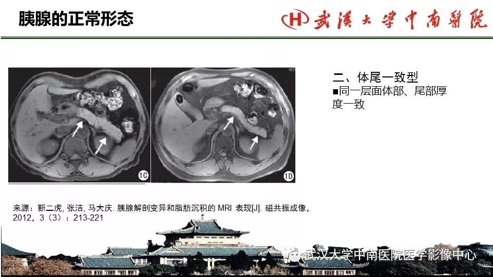 【PPT】胰腺正常解剖及形态变异、先天性疾病