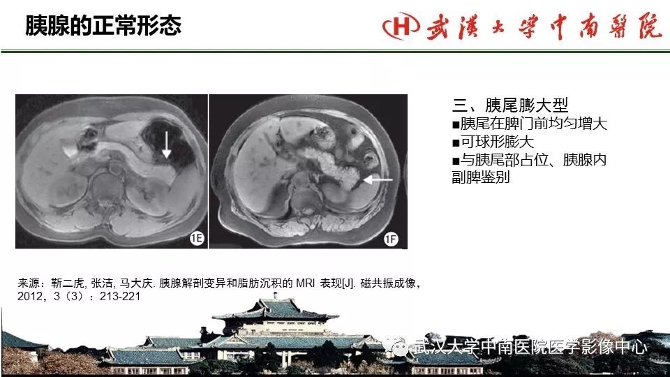 【PPT】胰腺正常解剖及形态变异、先天性疾病