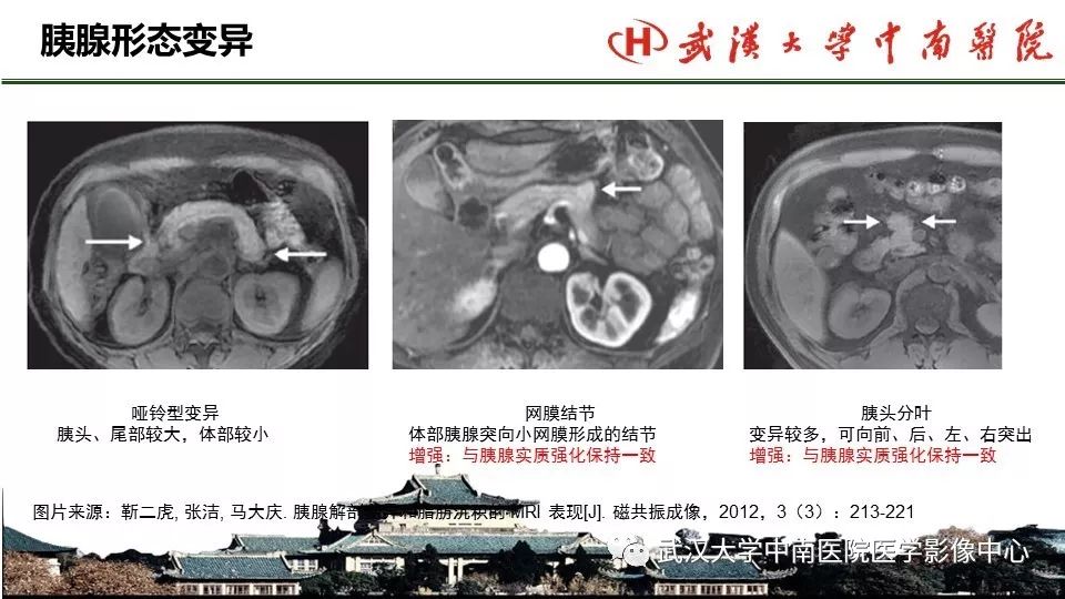 【PPT】胰腺正常解剖及形态变异、先天性疾病