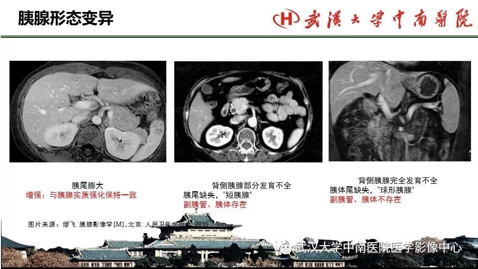 【PPT】胰腺正常解剖及形态变异、先天性疾病